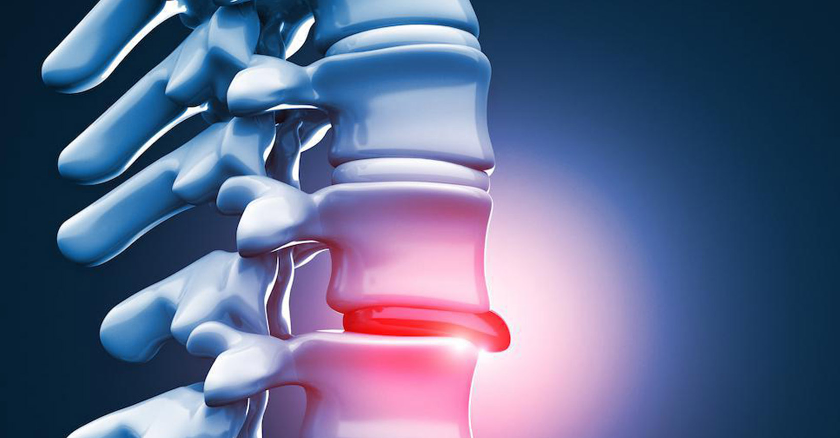Hérnias de disco com dores agudas e crônicas da coluna